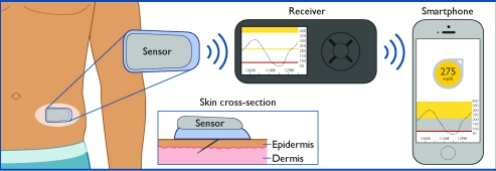 Flow of Glucose Data between CGM sensor, receiver, and smartphone. C. Lorenzo © 2017